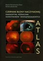Czerniak błony naczyniowej Diagnostyka różnicowa nowotworów wewnątrzgałkowych Atlas - Bożena Romanowska-Dixon, Barbara Jakubowska